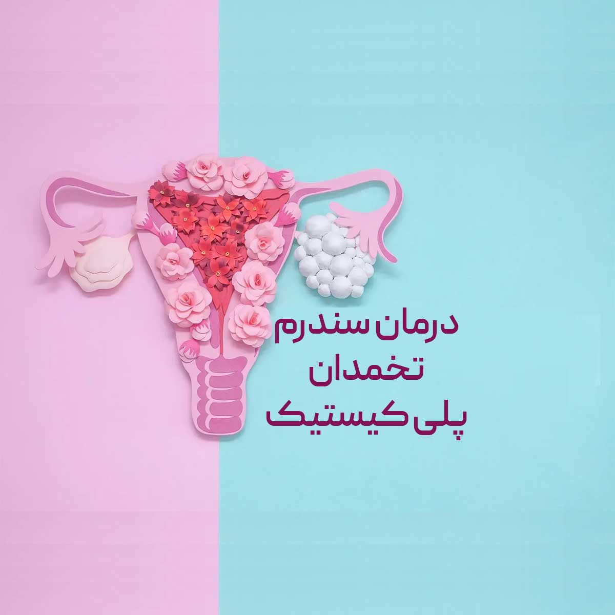 درمان سندرم تخمدان پلی کیستیک