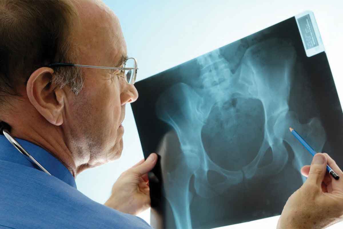 پوکی استخوان چیست؟