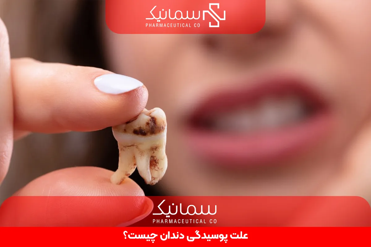 علت پوسیدگی دندان (Tooth Decay) چیست؟