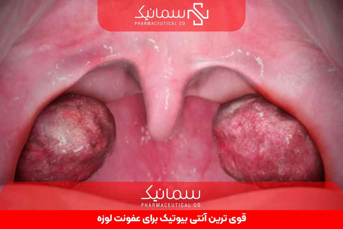 قوی ترین آنتی بیوتیک برای عفونت لوزه