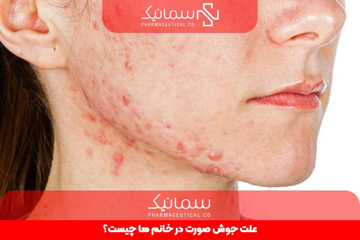 علت جوش صورت در خانم ها چیست؟