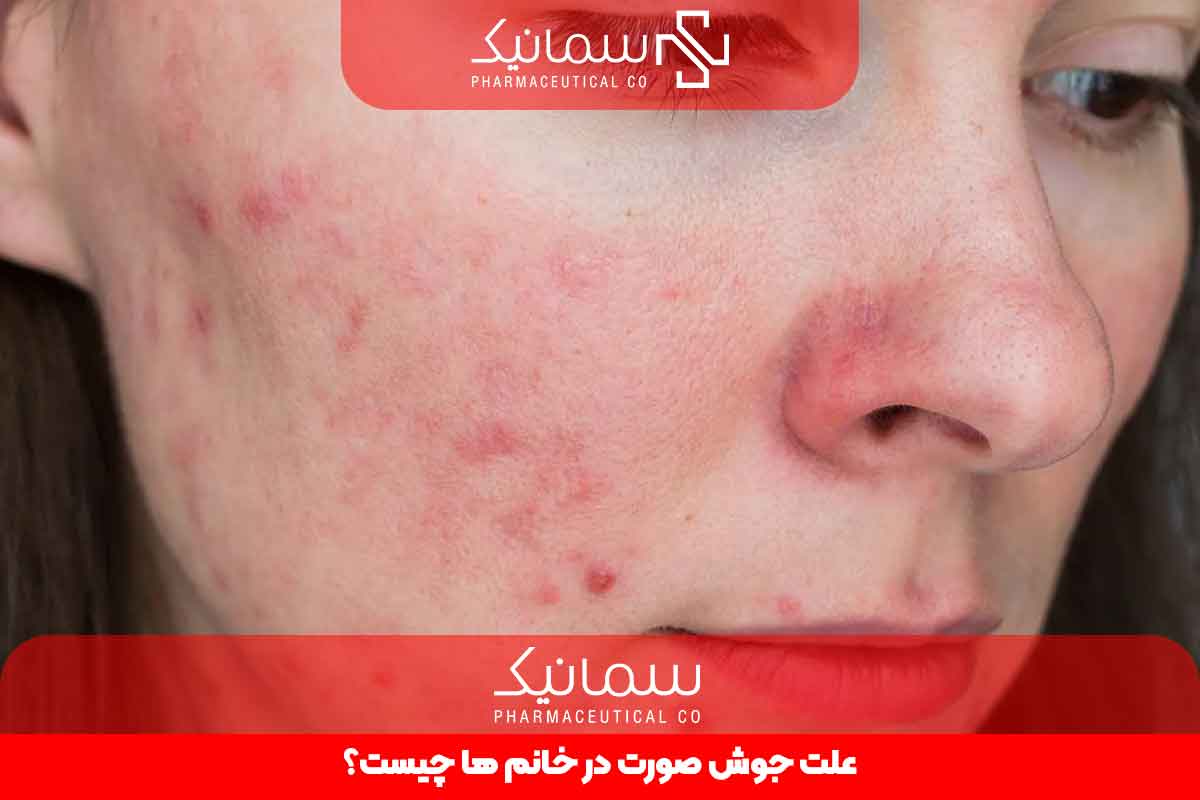 علت جوش صورت در خانم ها چیست؟
