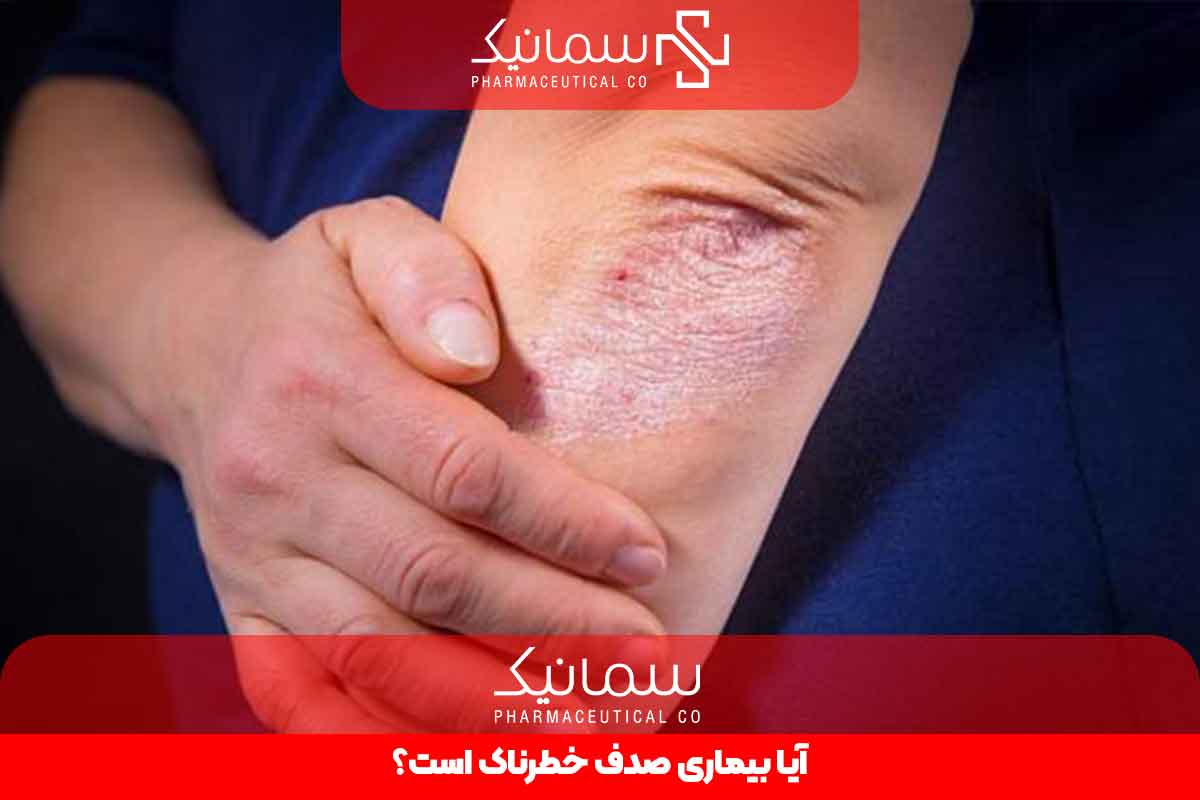 آیا بیماری صدف خطرناک است؟