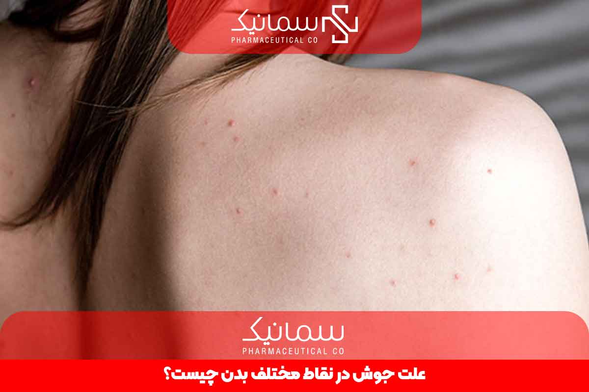 علت جوش در نقاط مختلف بدن چیست؟