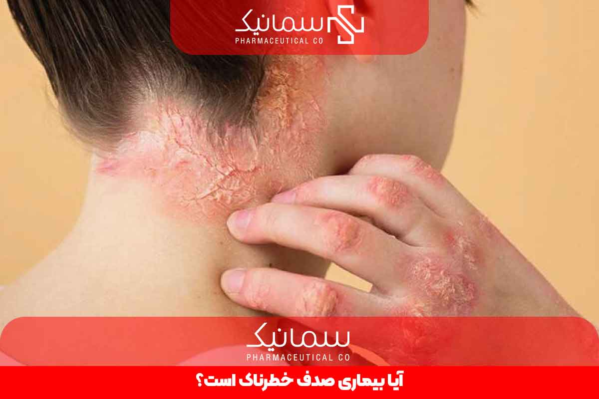 آیا بیماری صدف خطرناک است؟