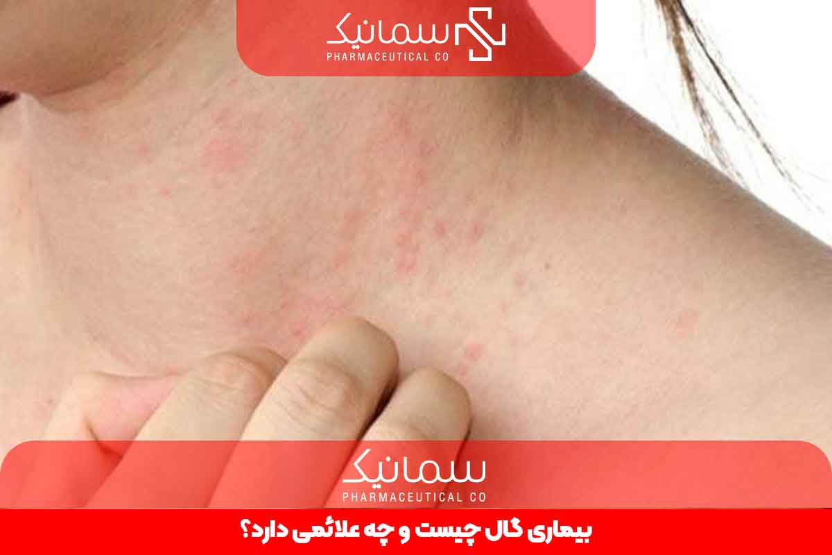 بیماری گال چیست و چه علائمی دارد؟