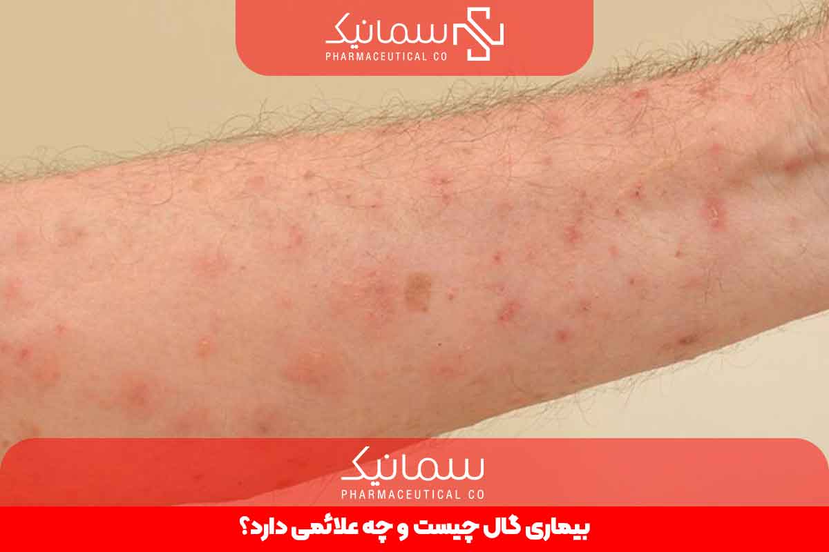 بیماری گال چیست و چه علائمی دارد؟