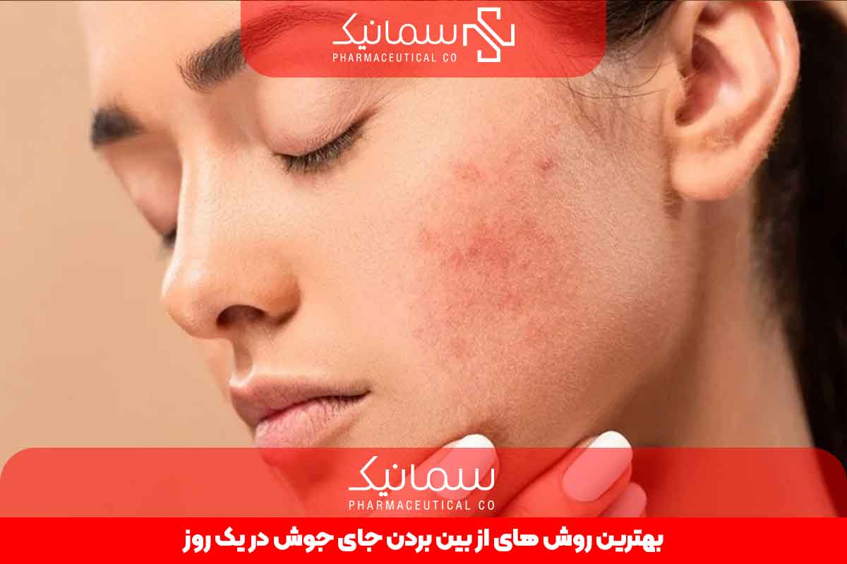 بهترین روش های از بین بردن جوش در یک روز