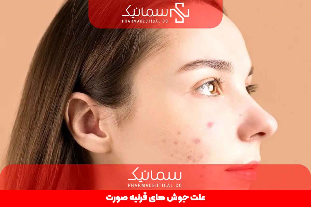 علت جوش های قرینه صورت