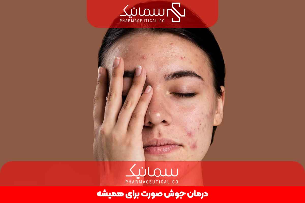 درمان جوش برای همیشه