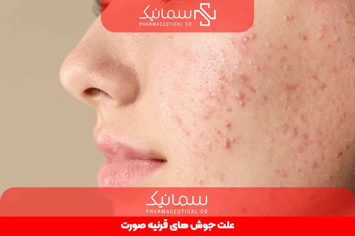 علت جوش های قرینه صورت