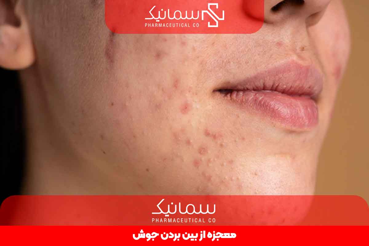 معجزه از بین بردن جوش
