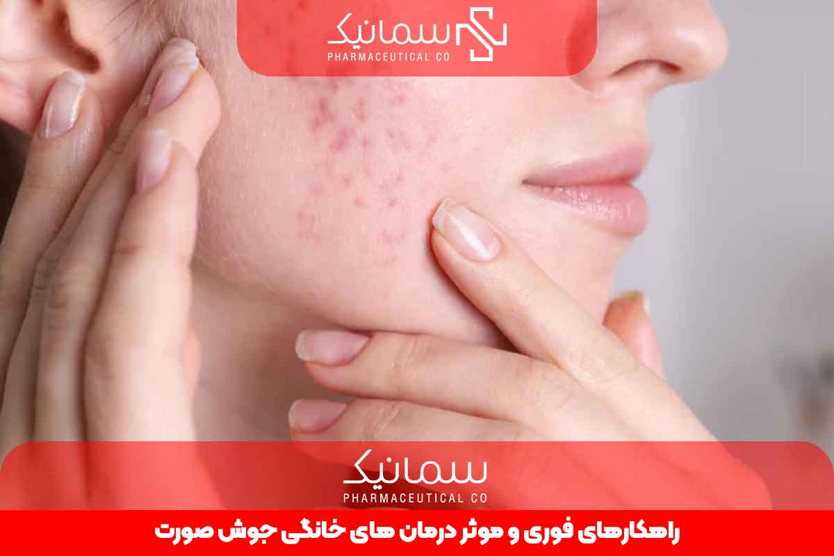 راهکاری های فوری و موثر درمان های خانگی جوش صورت