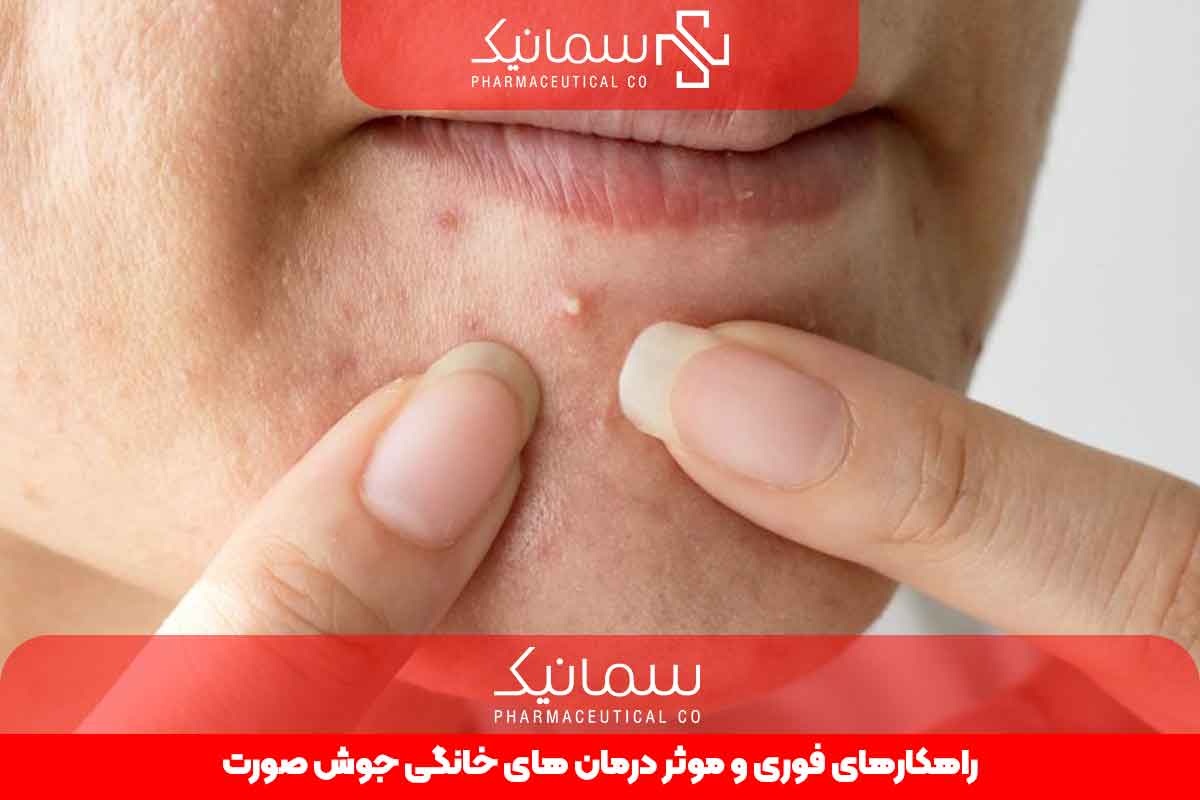 راهکاری های فوری و موثر درمان های خانگی جوش صورت