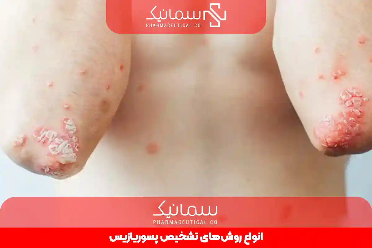 روش‌های تشخیص پسوریازیس