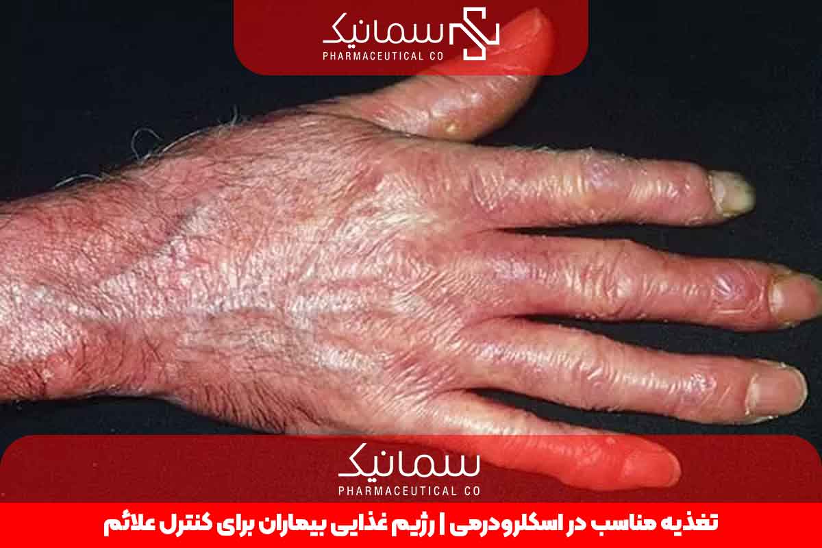 تغذیه مناسب در اسکلرودرمی