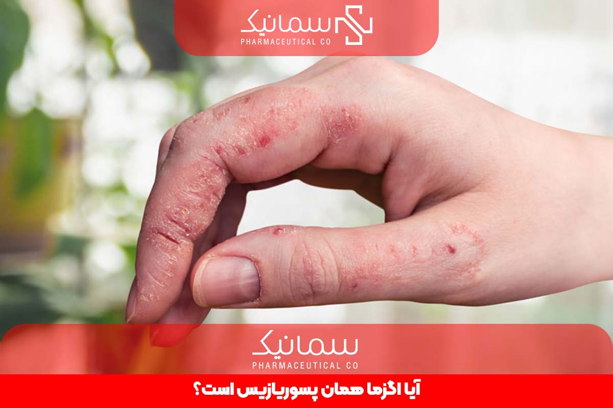 آیا اگزما همان پسوریازیس است؟