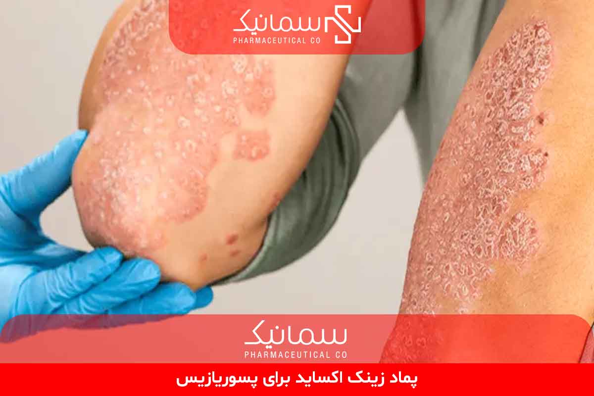 پماد زینک اکساید برای پسوریازیس