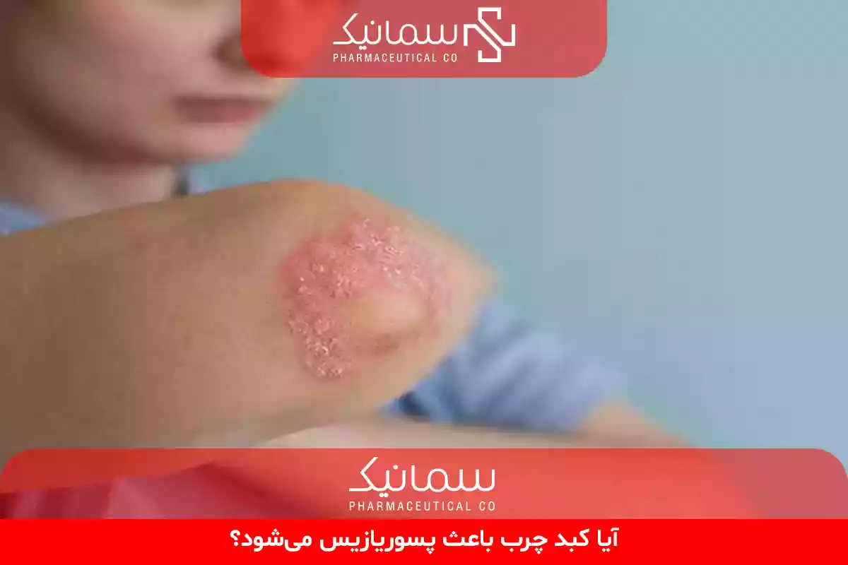 آیا کبد چرب باعث پسوریازیس میشود