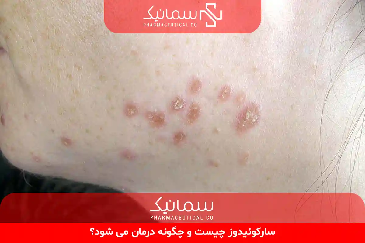 سارکوئیدوز چیست