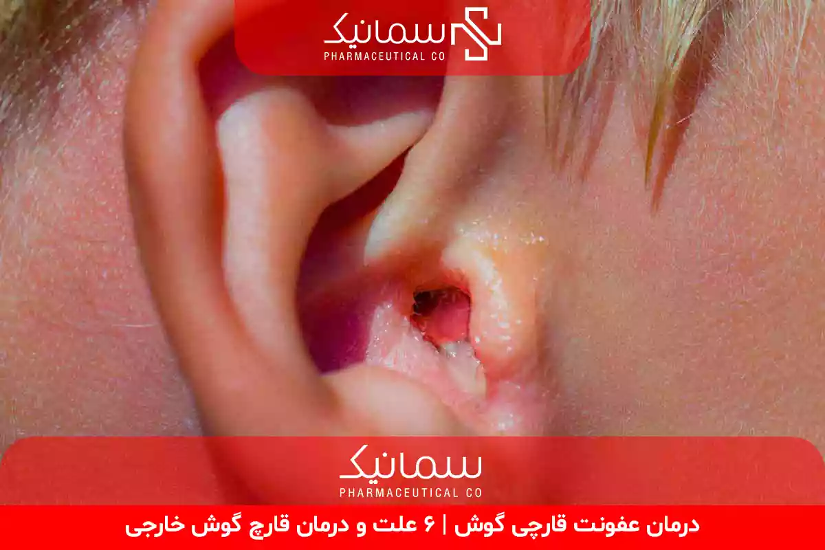 عفونت قارچی گوش