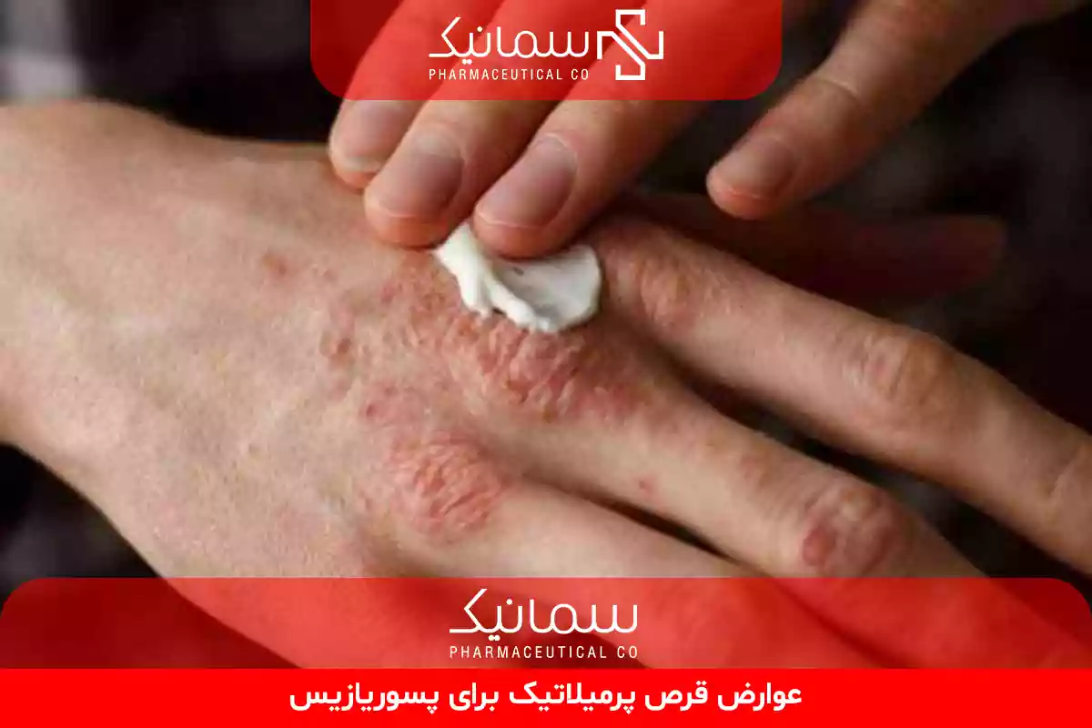 عوارض قرص پرمیلاتیک برای پسوریازیس