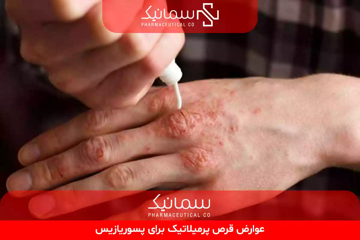 عوارض قرص پرمیلاتیک برای پسوریازیس