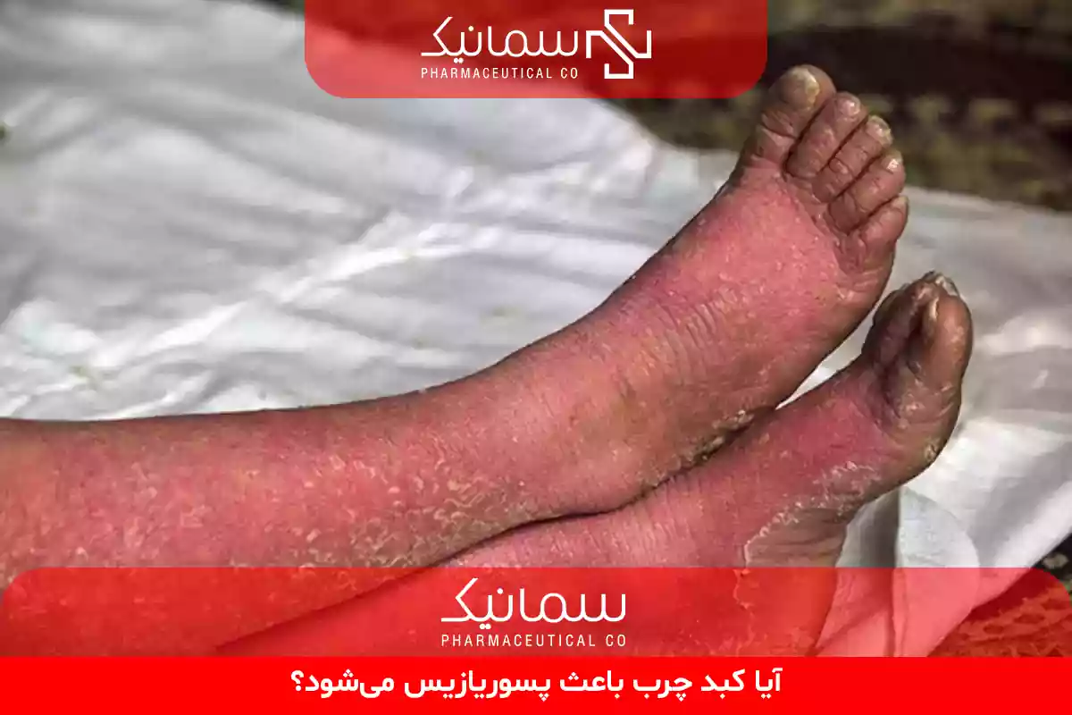 آیا کبد چرب باعث پسوریازیس می‌شود
