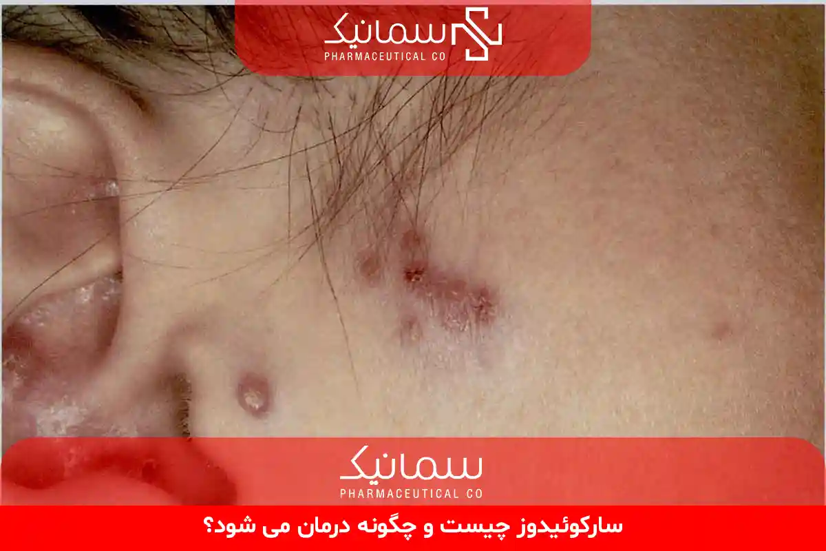 سارکوئیدوز چیست