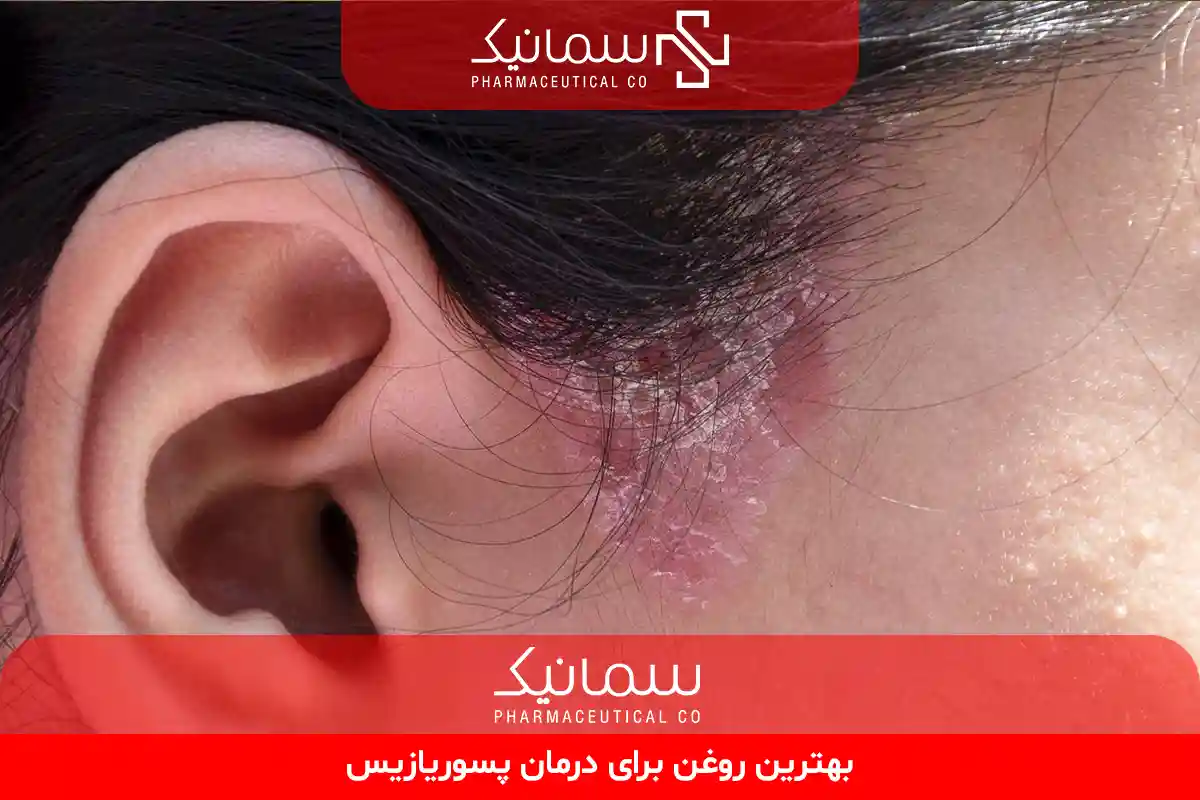 بهترین روغن برای درمان پسوریازیس