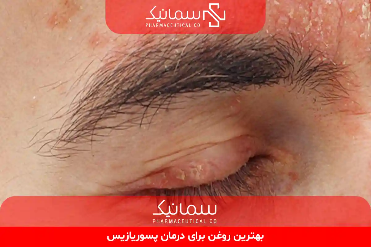 بهترین روغن برای درمان پسوریازیس
