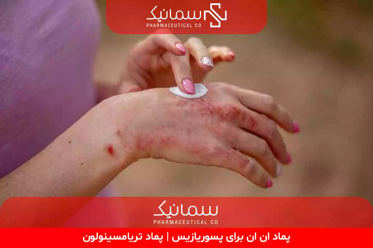 پماد ان ان برای پسوریازیس