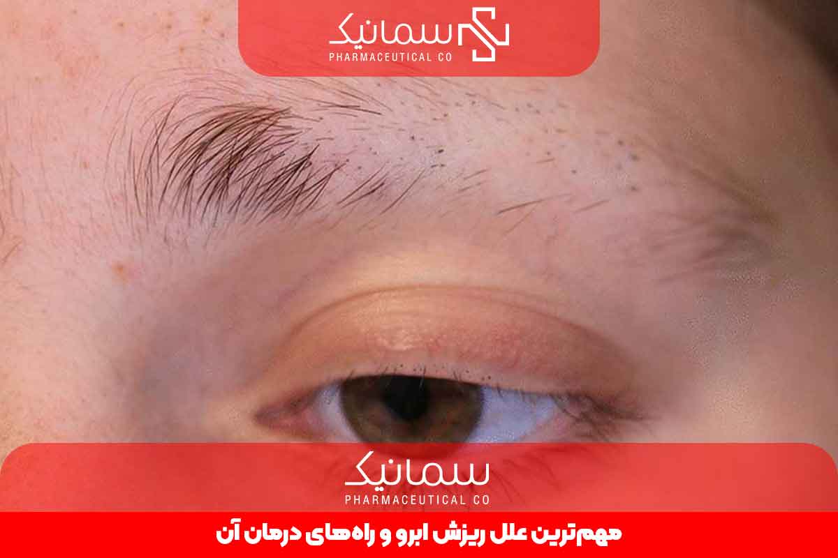 ریزش ابرو