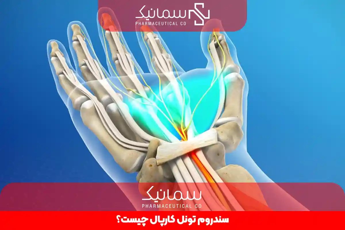 سندروم تونل کارپال