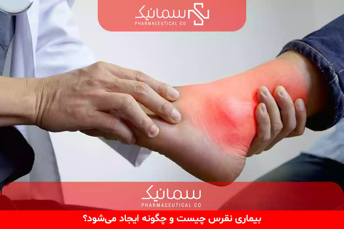 نقرس