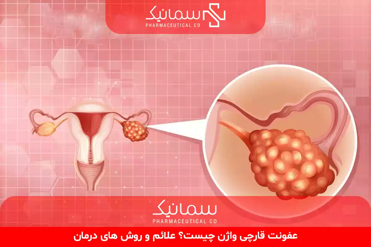 عفونت قارچی واژن