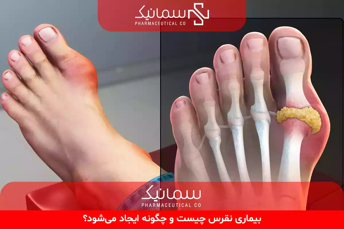 نقرس