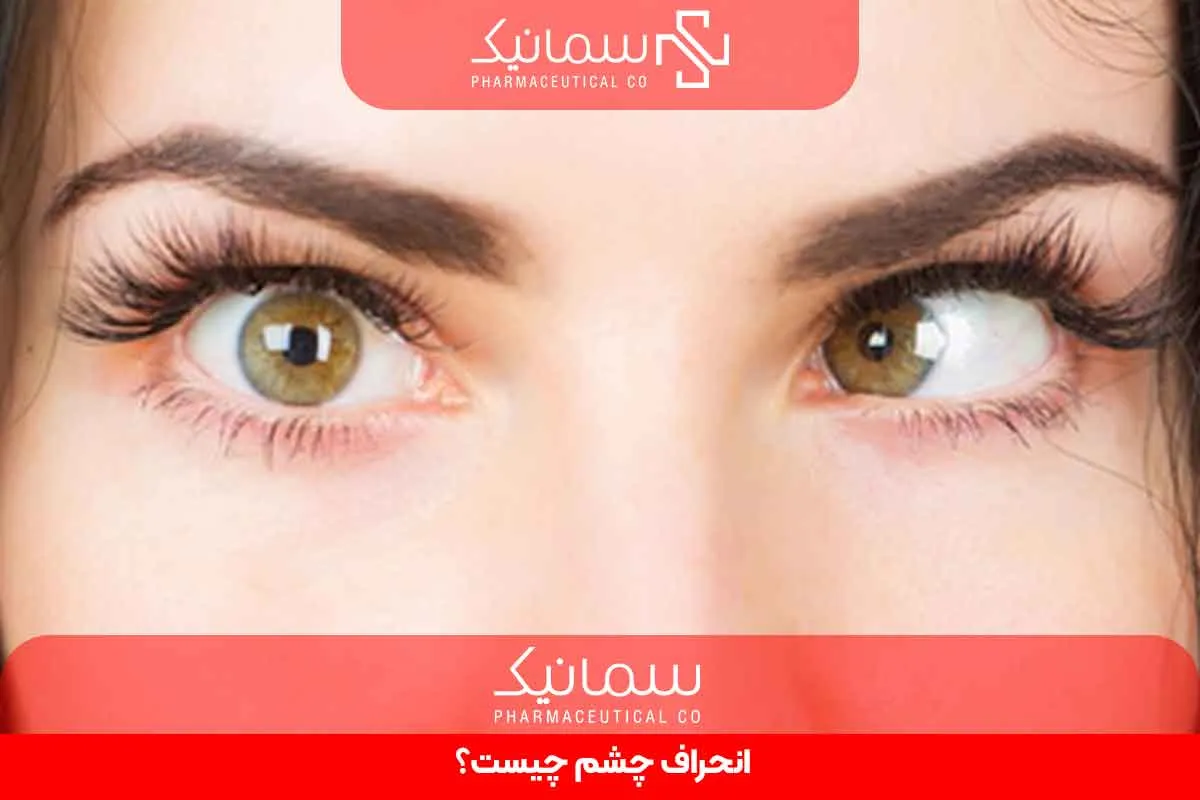 انحراف چشم