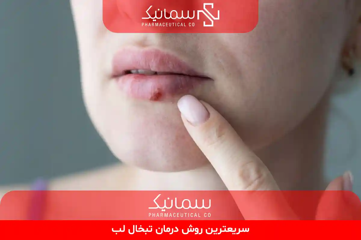 درمان تبخال لب