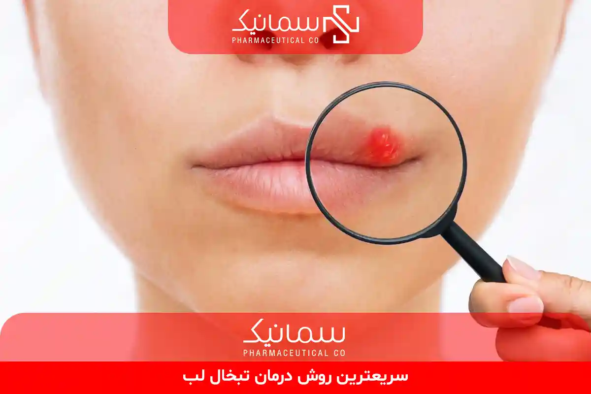 درمان تبخال لب
