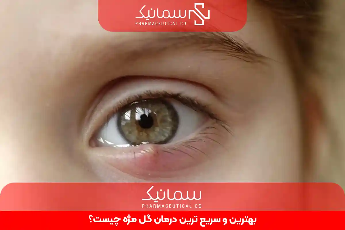 سریع ترین درمان گل مژه
