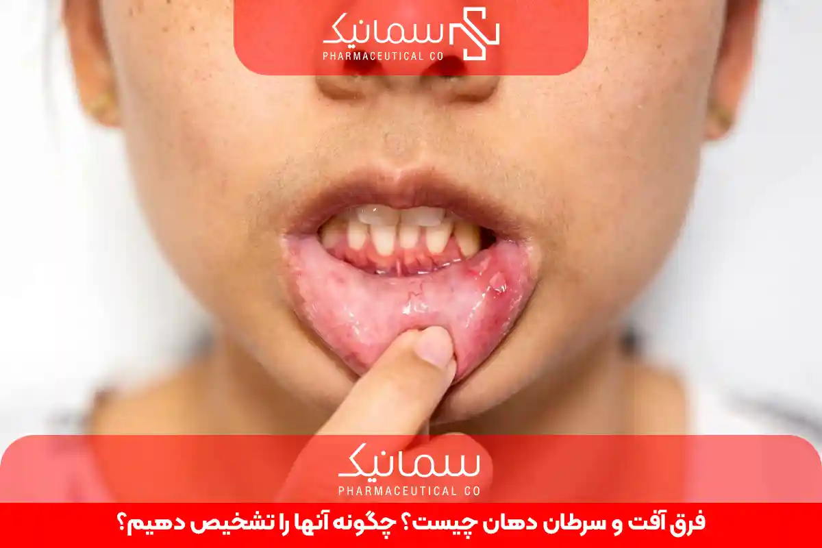 فرق آفت و سرطان دهان