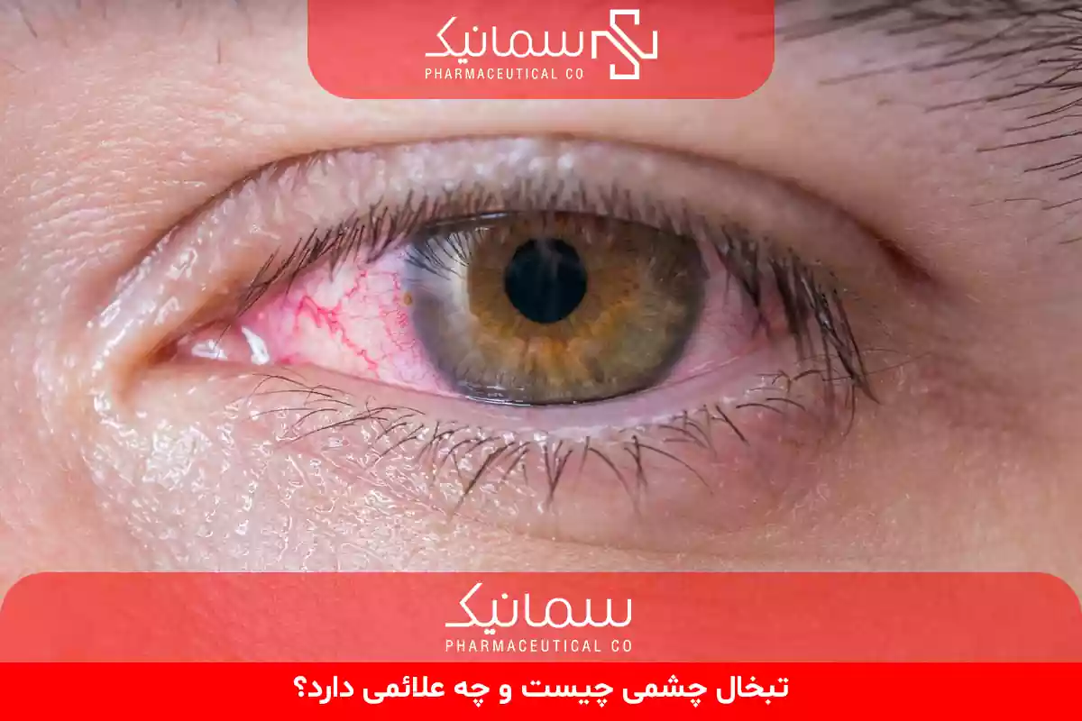 تبخال چشمی