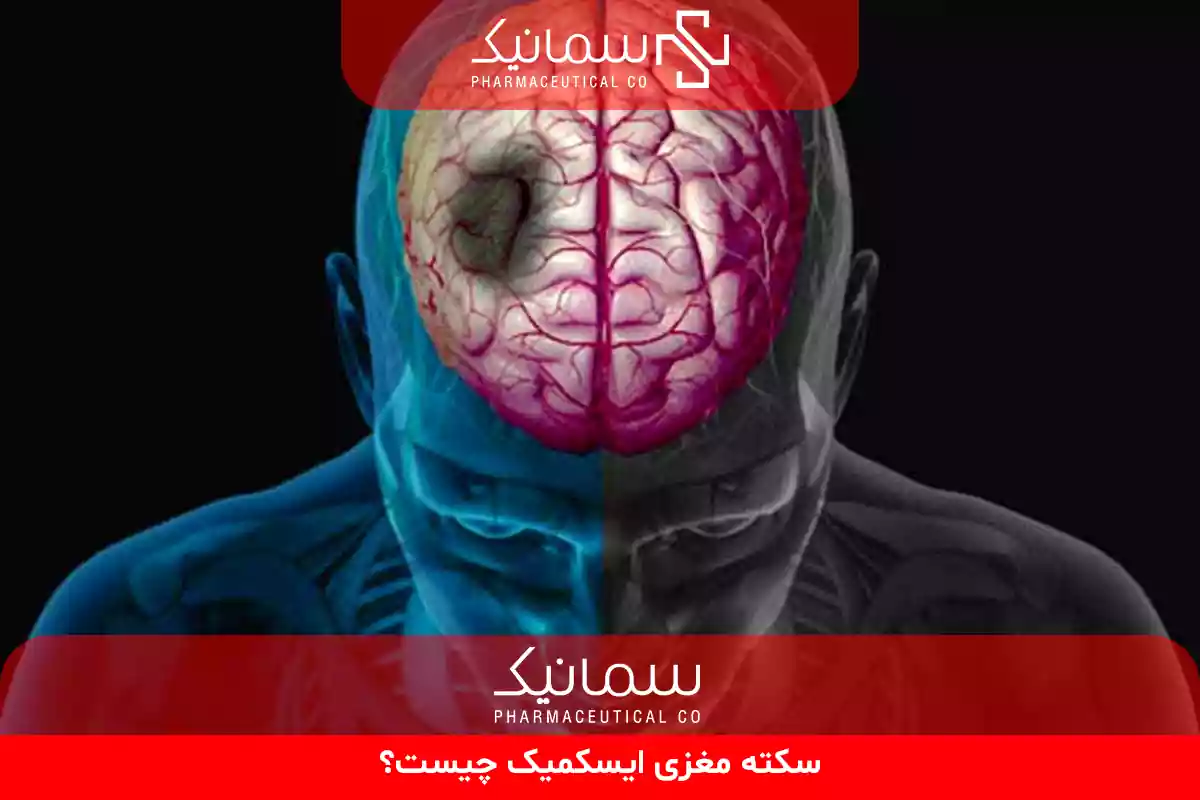 سکته مغزی ایسکمیک