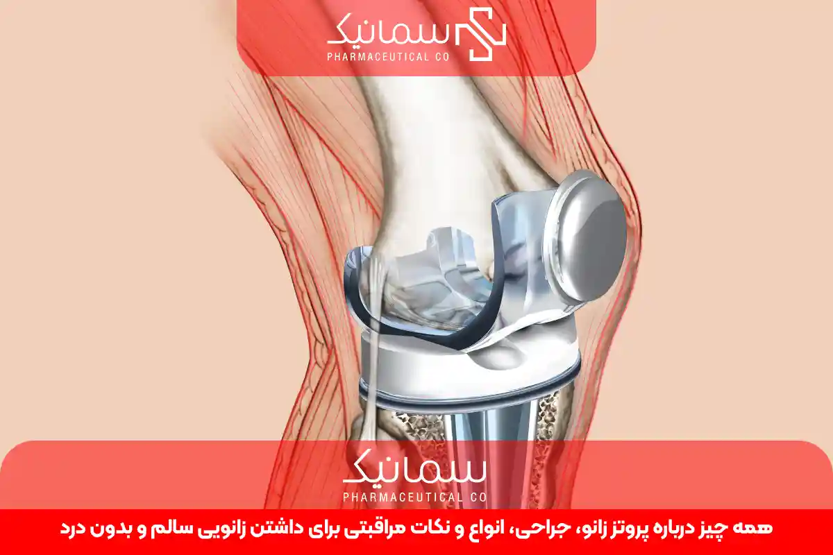 پروتز زانو