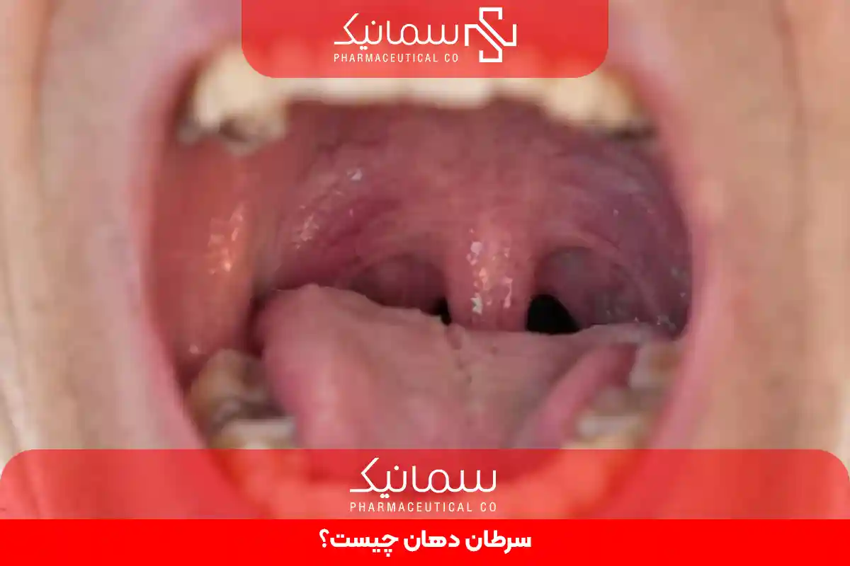 سرطان دهان