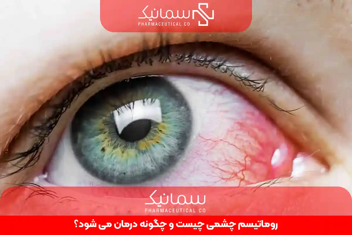 روماتیسم چشمی