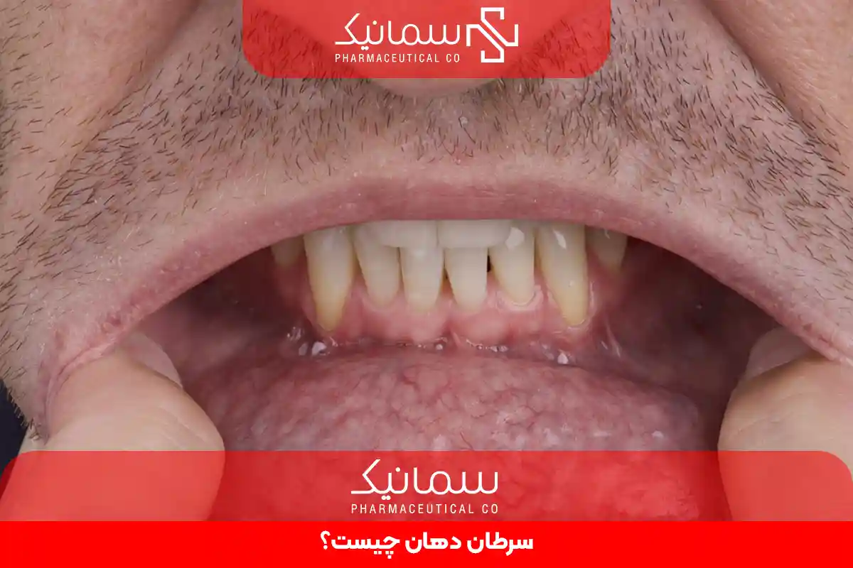 سرطان دهان