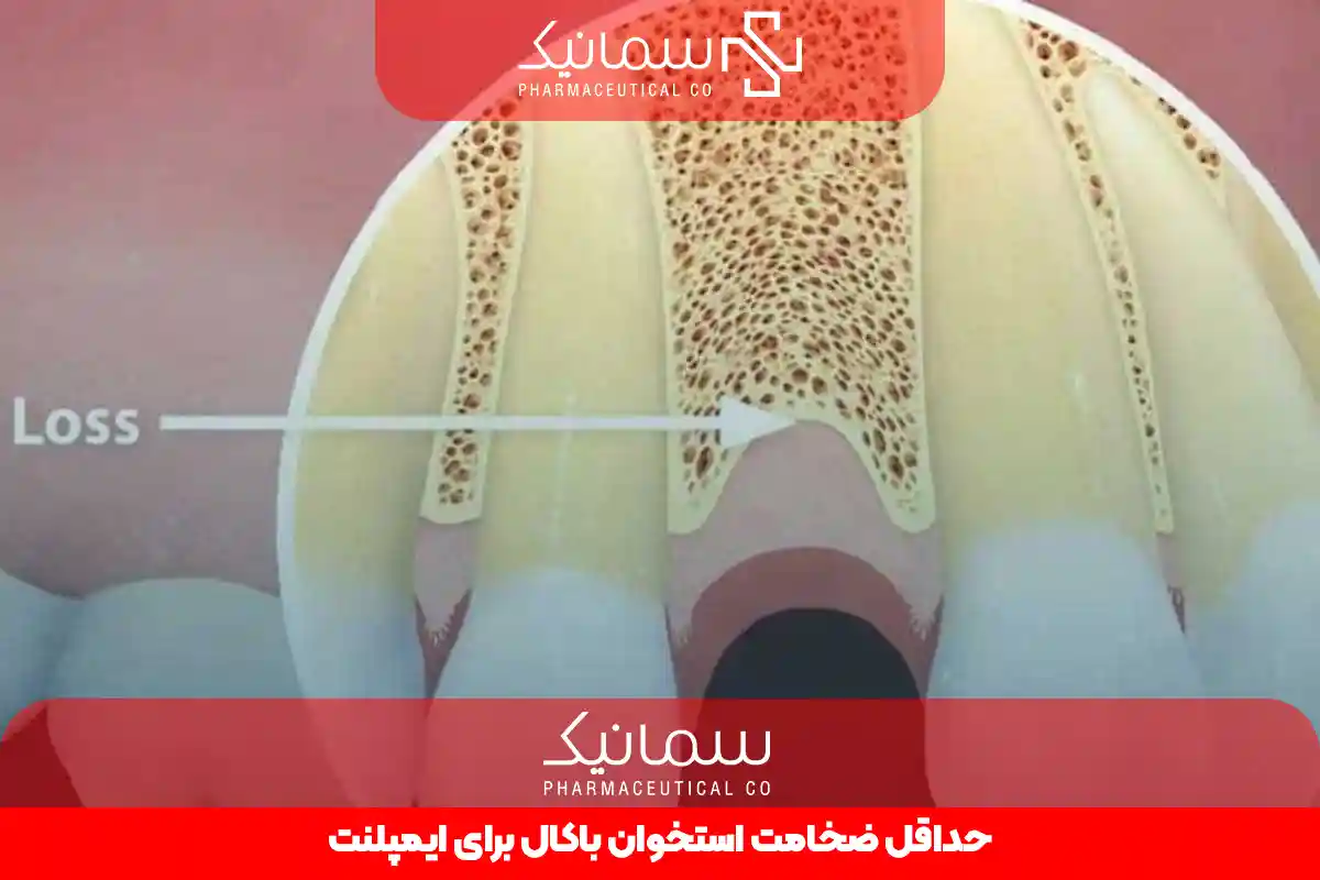 حداقل ضخامت استخوان باکال برای ایمپلنت