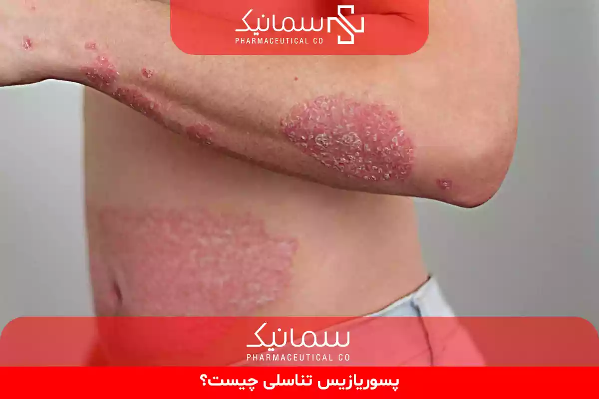 پسوریازیس تناسلی